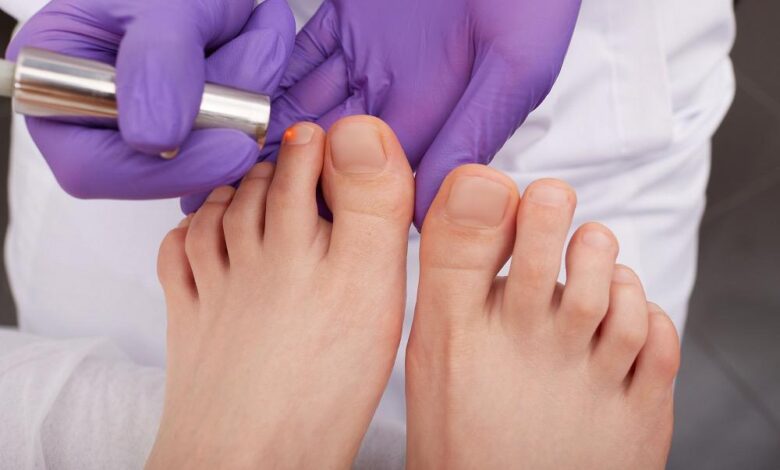 What Is Laser Treatment for Fungal Toenails, and How Does It Work?